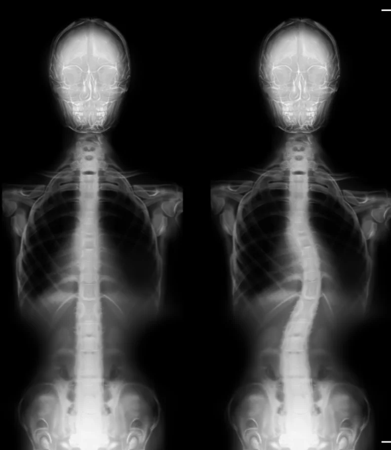 scoliosis Los Angeles CA